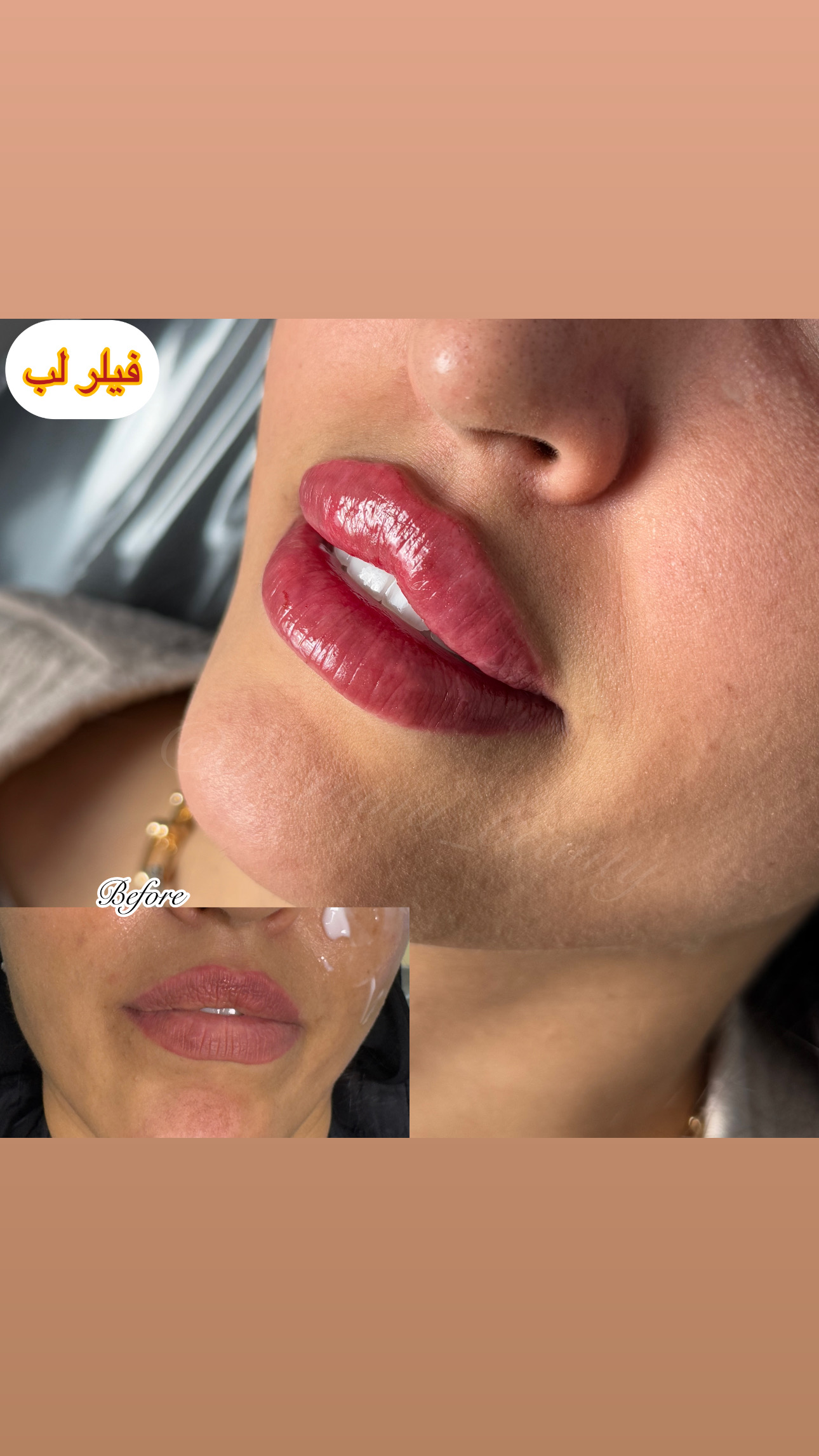 تزریق تخصصی فیلر لب در ساری